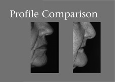 Profiles of healthy jaw bone and resorbed bone.