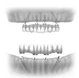 Just 4 Implants Support Non-Removable Teeth In Minimal Bone