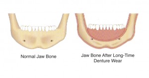 Healthy Jaw Bone Vs Bone Loss From Wearing Dentures