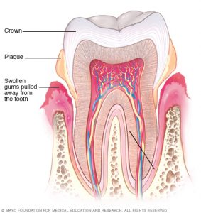 Mayo Clinic image showing perio disease