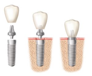 implant-components