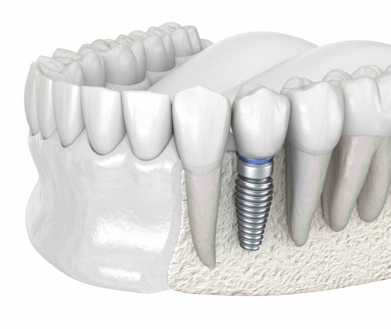 Know The Qualifications of Who Places Your Dental Implants. William J